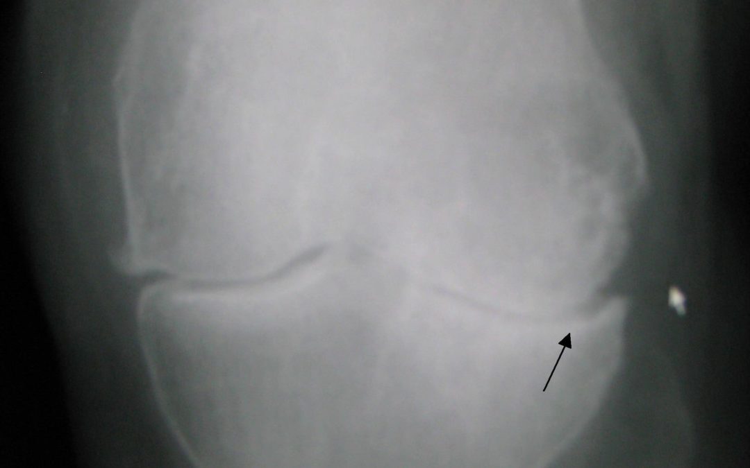 People with an ACL Reconstruction are Five Times More Likely to Need a Knee Replacement Later On